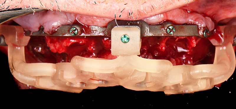 implantologie guidée : positionnement du guide de forage.