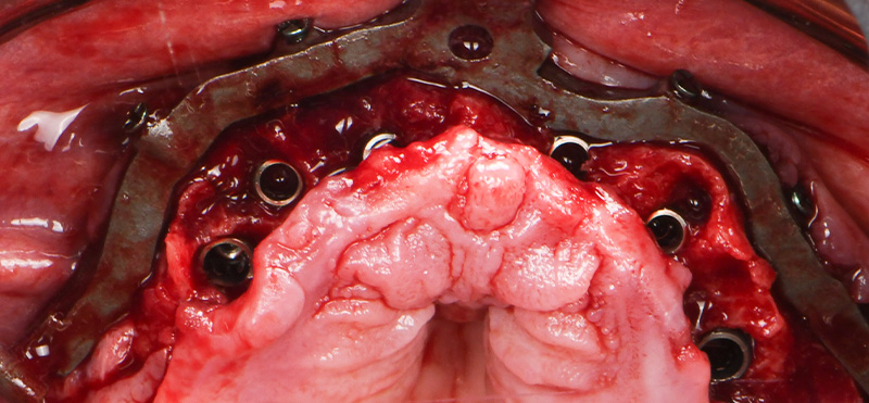 implantologie guidée : positionnement des multi-units droits.