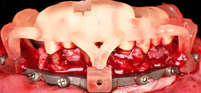 implantologie guidée : positionnement des multi-units droits appliqués à la mandibule.