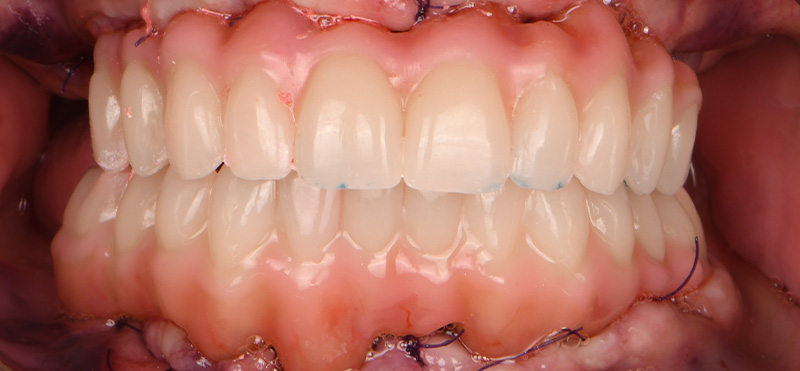 Zoom sur les nouvelles dents du patient, après intervention