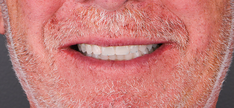 résultat final du patient, belles dents blanches