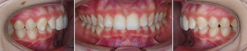 Carriere Motion®, Cas clinique