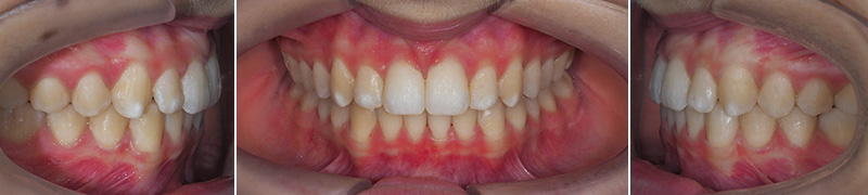 Carriere Motion®, vues endobuccales de fin de traitement