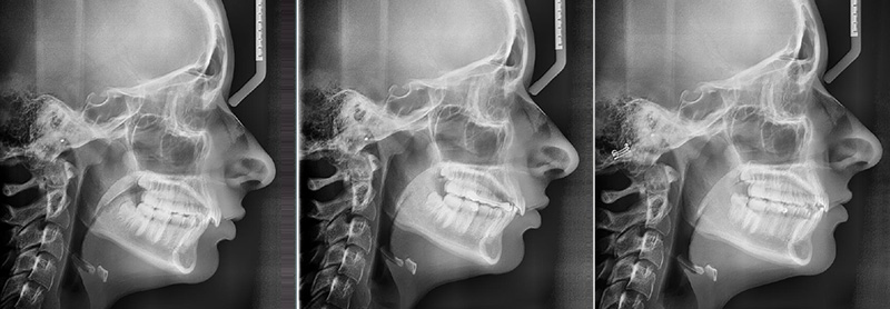 amélioration significative du profil