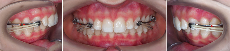 Carriere Motion®, pose