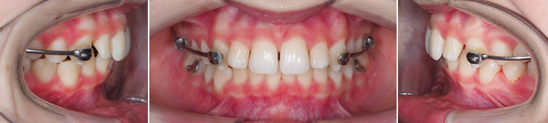 Carriere Motion®, correction de la classe 2