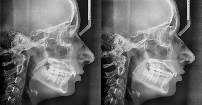 Carriere Motion®, amélioration du profil