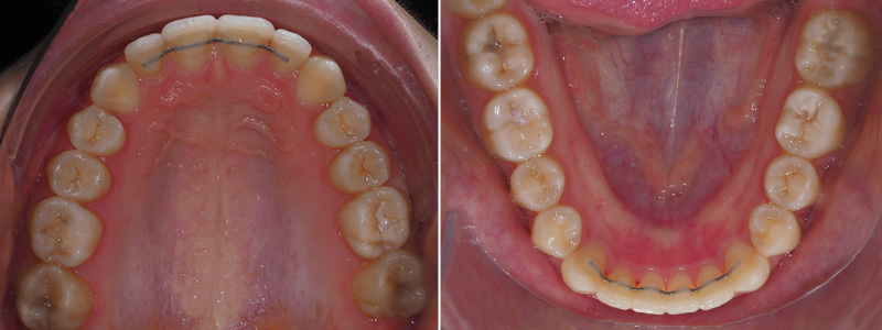 Carriere Motion®, vues endobuccales de fin de traitement