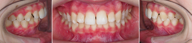 Carriere Motion®, élaboration du Clincheck