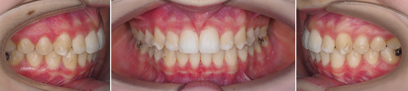 Carriere Motion®, étape de finition