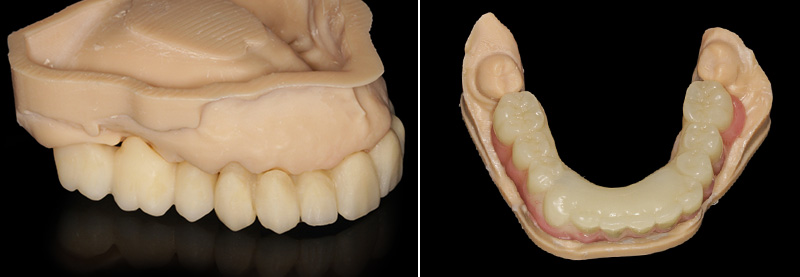 Confection des prothèses d’usage