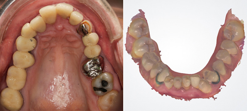 Photographie intra-orale et IOS initiaux - Flux numérique