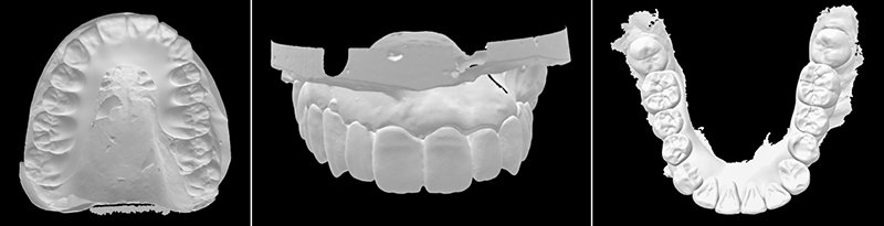 Protocole de réhabilitation - Wax up numérique maxillaire et mandibulaire