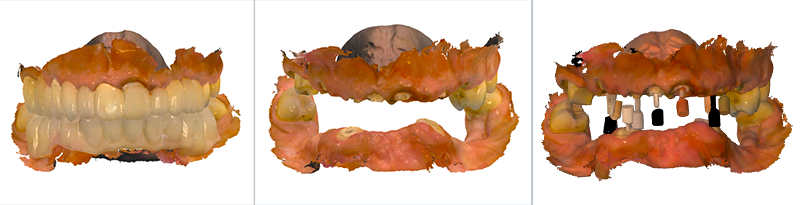 Empreinte numérique des RCR maxillaires en pré-préparation