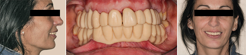 Confection d’une maquette d’essayage amovible en résine PMMA