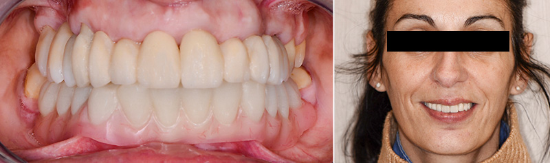 Assemblage des prothèses d’usage