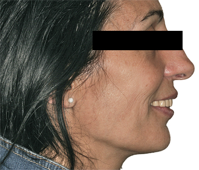 Protocole de réhabilitation numérique - Photographie initiale extra-orale de profil