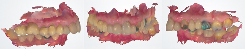 Photographie intra-orale et IOS initiaux, vue occlusale maxillaire et mandibulaire