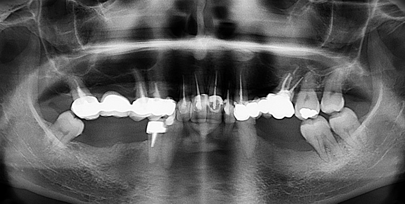 Orthopantomographie initiale