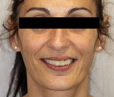 bridge transitoire maxillaire