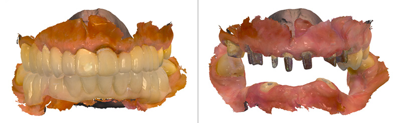 protocole d’empreinte numérique des préparations périphériques