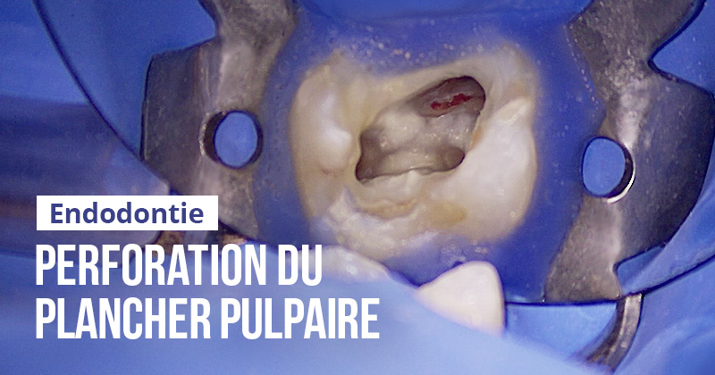 Top 5 -Rémy Gombert, endo perforation