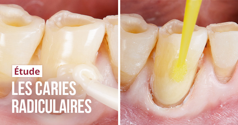 Caries radiculaires par Falk Fchwendicke