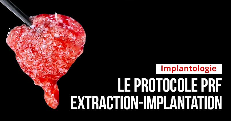 Article de Julien BITON sur l'Extraction implantation