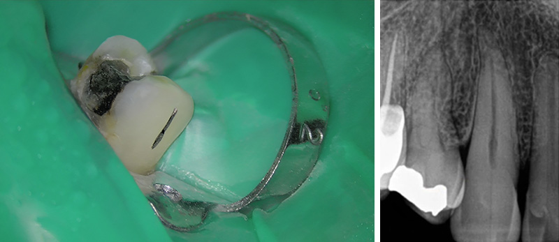 erreurs à ne pas commettre en endodontie