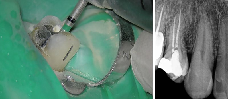 erreurs à ne pas commettre en endodontie