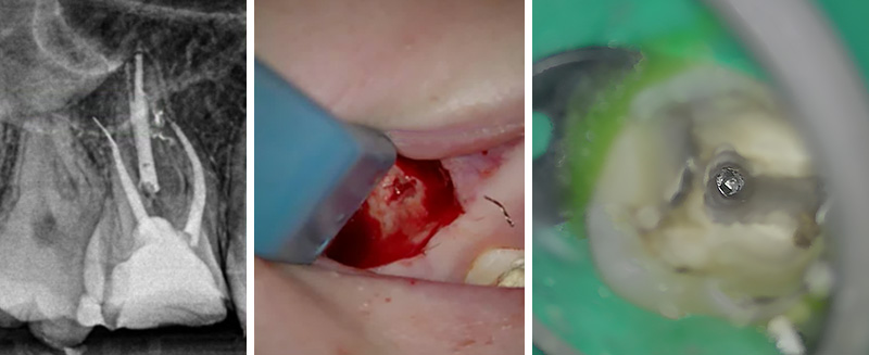 erreurs à ne pas commettre en endodontie