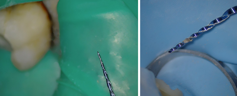 erreurs à ne pas commettre en endodontie