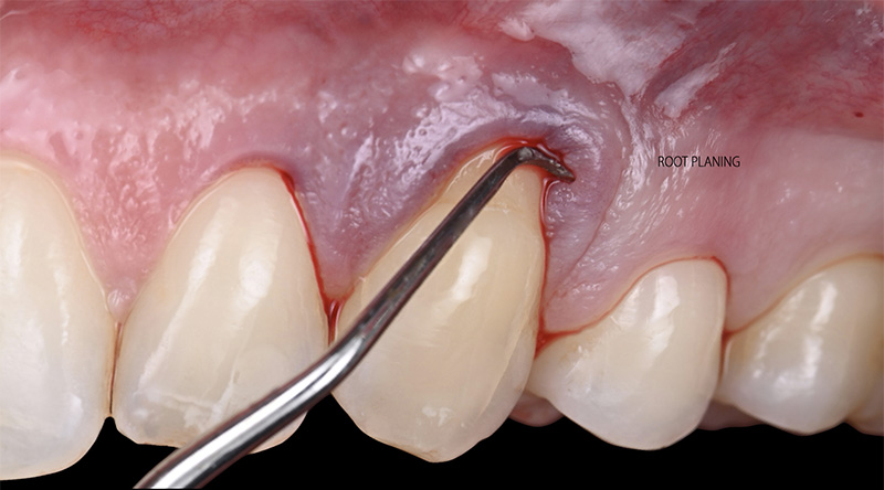 Surfaçage de la zone radiculaire