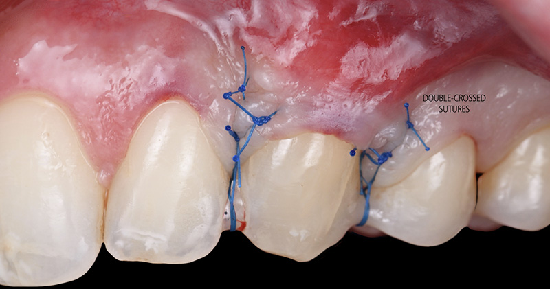Situation post-opératoire immédiate avec sutures