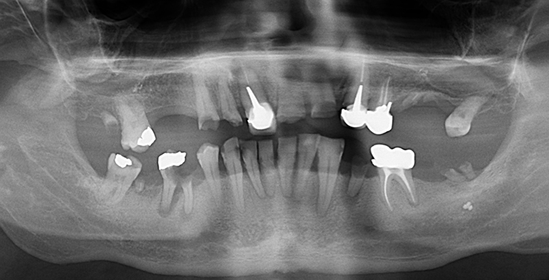 Radio hygiène orale implants