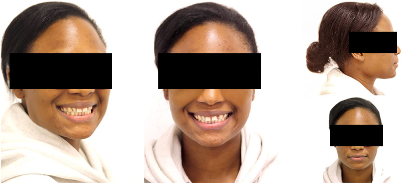 diastèmes, aligneurs, état initial