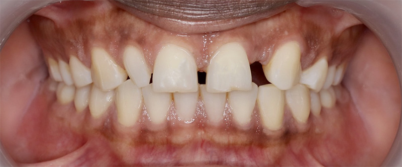 Aligneurs, diagnostic