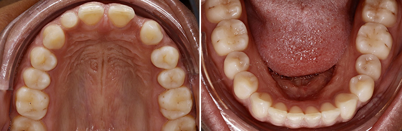 diastèmes, aligneurs, maxillaire supérieur et inferieure
