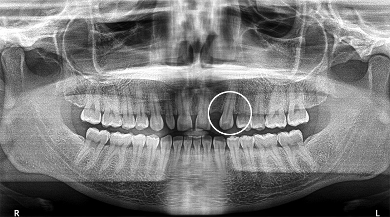 Radiographie Panoramique