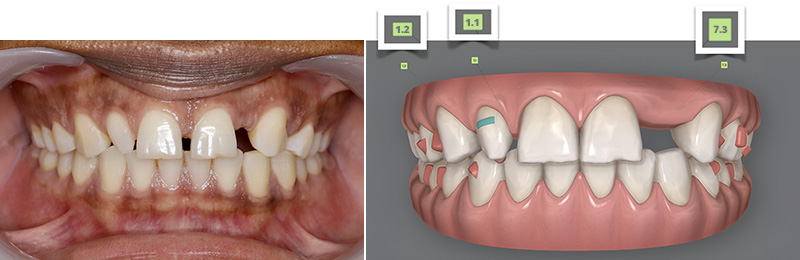 diastèmes, aligneurs, déplacements