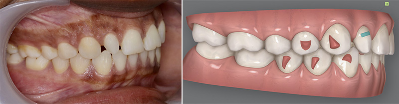 diastèmes, aligneurs, déplacements