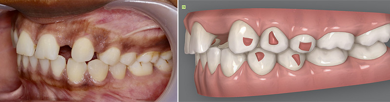 diastèmes, aligneurs, déplacements
