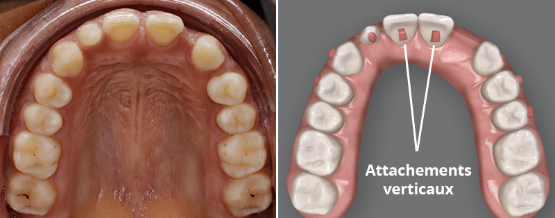 Aligneur, attachements verticaux