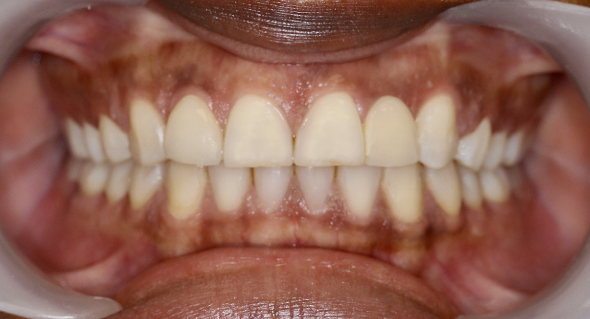 Aligneur, état final