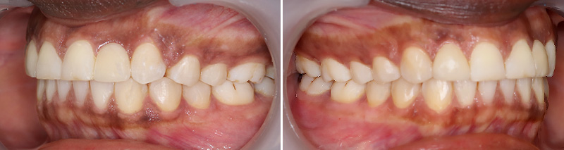 Cotés gauche et droit, état final