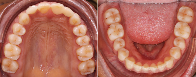 Aligneurs, Maxillaire supérieur et inferieure final