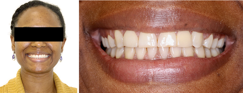 Aligneurs, situation finale