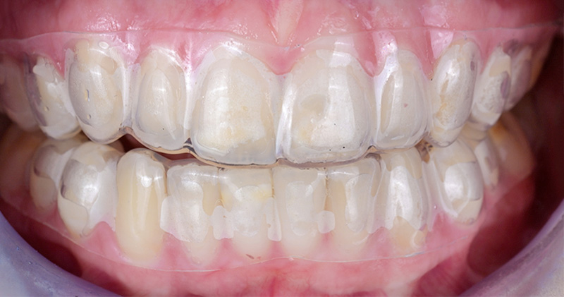 L’éclaircissement dentaire, essayage des gouttières en bouche