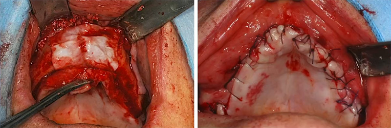 Nasal lift, cas clinique