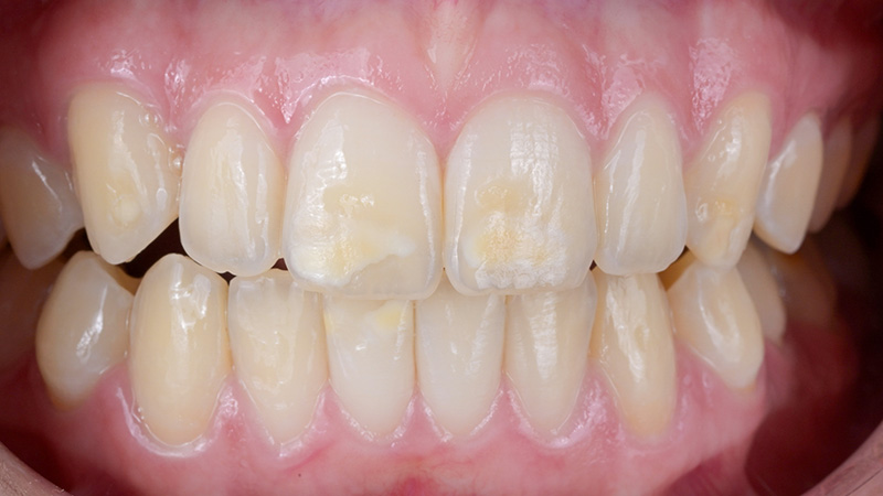 éclaircissement dentaire, situation initiale Intrabuccale